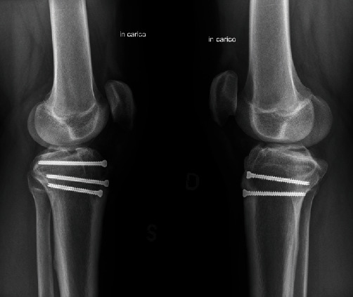 Simultaneous Bilateral Avulsion of Tibial Anterior Tubercle in Adolescent: Two Case Reports and Narrative Review of the Literature.