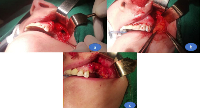 Successful Closure of an Oro-Antral Communication, after Three Previously Failed Attempts, Using Bichat Fat Pad Flap: A Case Report.