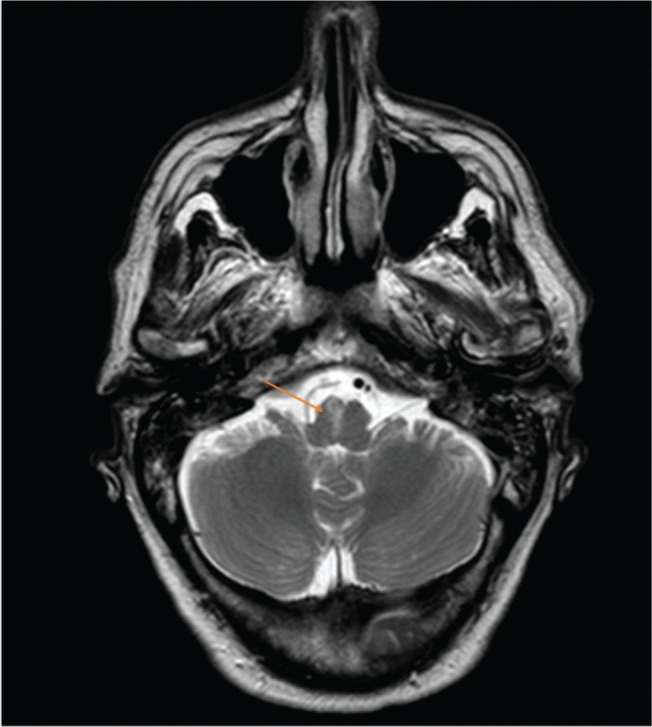 Acute meningitis complicated with ventriculitis caused by <i>Streptococcus dysgalactiae subsp. dysgalactiae</i>.