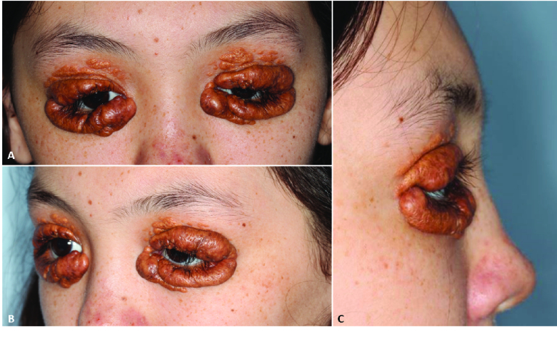 A Multifaceted Approach to Treatment of Recalcitrant Cutaneous Periorbital Juvenile Xanthogranuloma.