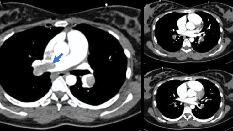 Pulmonary Thromboembolism in Pregnancy: A Case Report and Literature Review.