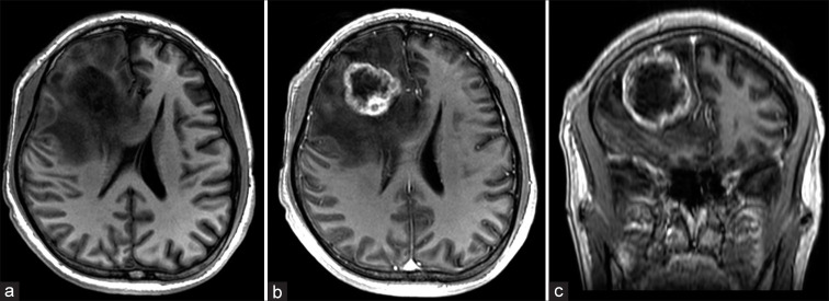 Uncommon metastases to the brain: Frontal lobe myoepithelial carcinoma.