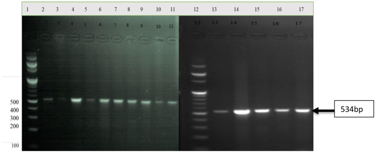 Detecting the Frequency of c.5946delT Pathogenic Variant in the <i>BRCA2</i> Gene and Associated Risk Factors Among Breast Cancer Patients Visiting Felege Hiwot Referral Hospital and University of Gondar Comprehensive Specialized Hospital.