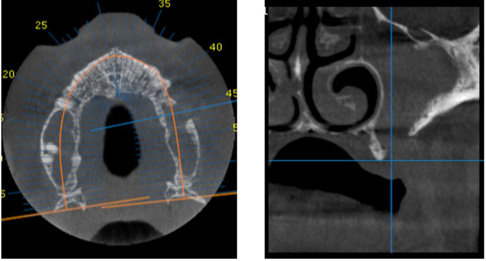 Successful Closure of an Oro-Antral Communication, after Three Previously Failed Attempts, Using Bichat Fat Pad Flap: A Case Report.