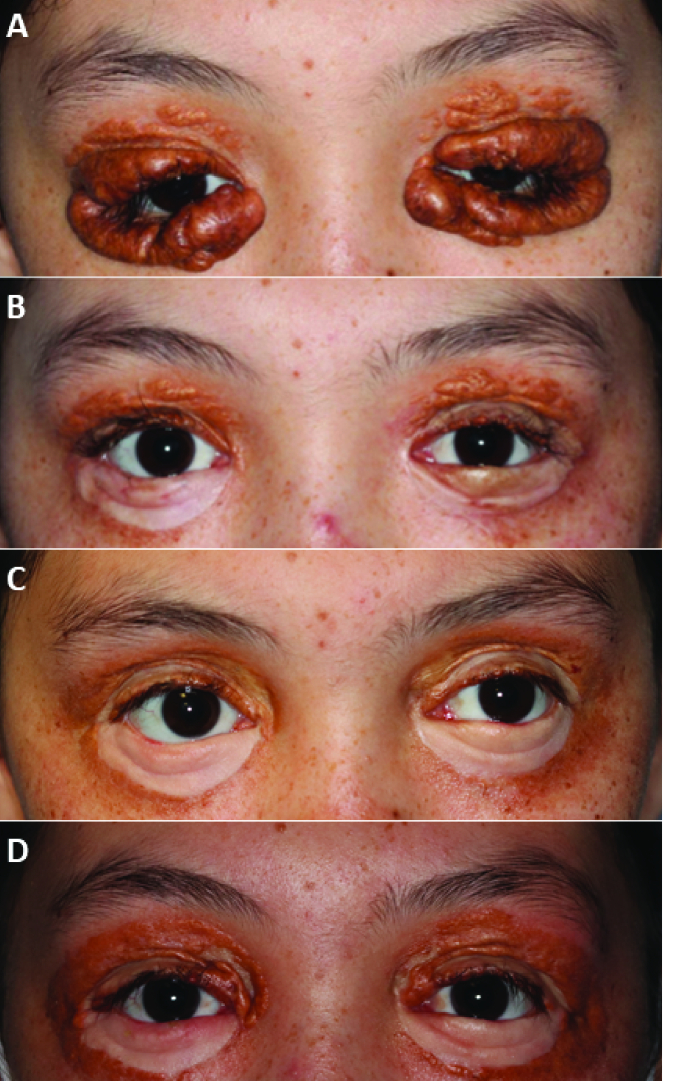 A Multifaceted Approach to Treatment of Recalcitrant Cutaneous Periorbital Juvenile Xanthogranuloma.