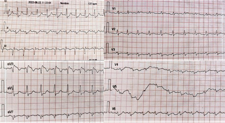 Pulmonary Thromboembolism in Pregnancy: A Case Report and Literature Review.