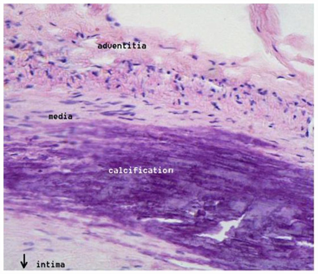 Salt-Sensitive Hypertension: Mediation by Salt-Induced Hypervolemia and Phosphate-Induced Vascular Calcification.