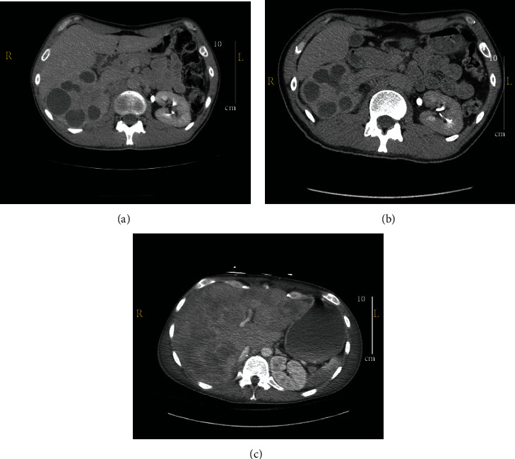 Concurrent Xanthogranulomatous Pyelonephritis and Upper Urinary Tract Transitional Cell Carcinoma.