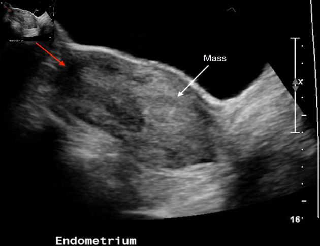 Uterine Inversion Secondary to Endometrial Carcinoma.