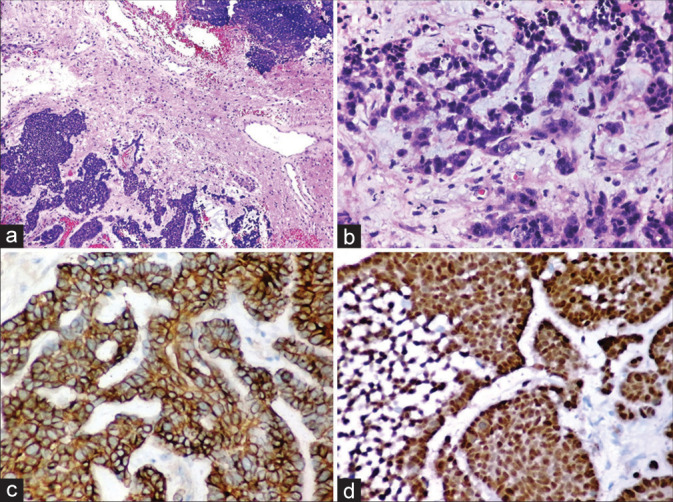 Uncommon metastases to the brain: Frontal lobe myoepithelial carcinoma.