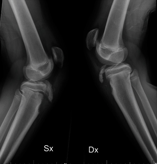 Simultaneous Bilateral Avulsion of Tibial Anterior Tubercle in Adolescent: Two Case Reports and Narrative Review of the Literature.