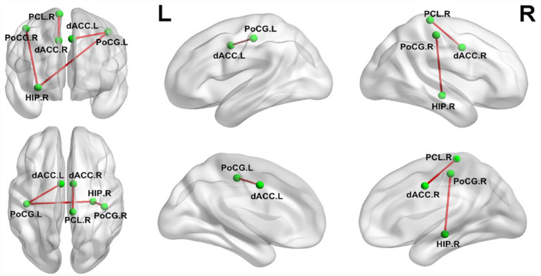 Altered whole-brain resting-state functional connectivity and brain network topology in typhoon-related post-traumatic stress disorder.