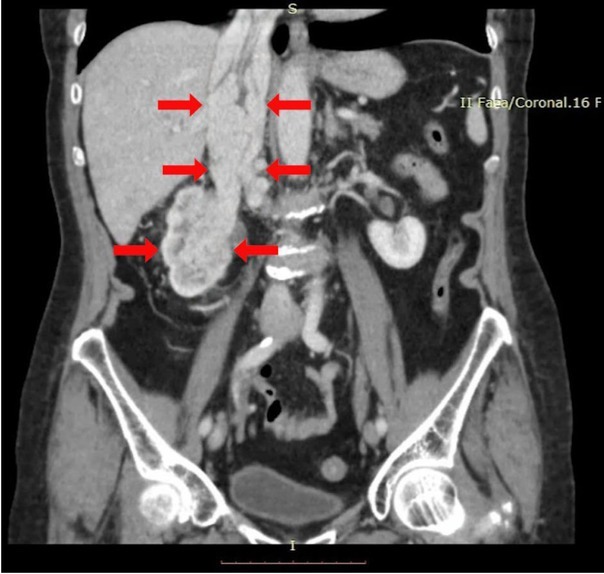 The Role of Intraoperative Transesophageal Echocardiography in the Management of Renal Cell Carcinoma with Atrial Thrombus - Case Report.