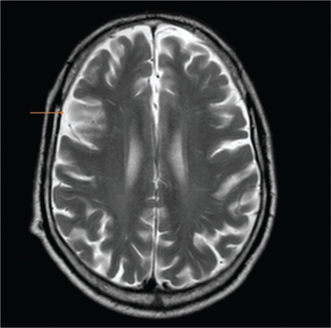 Acute meningitis complicated with ventriculitis caused by <i>Streptococcus dysgalactiae subsp. dysgalactiae</i>.