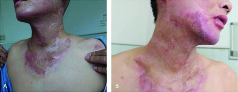 Real-world management of abnormal scarring using topical silicone gel: expert consensus and case series from the Asian SCARS Expert Group.