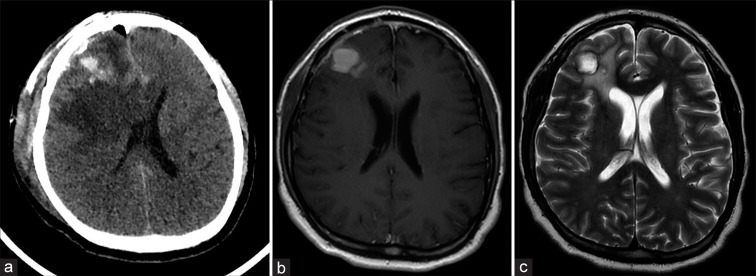 Uncommon metastases to the brain: Frontal lobe myoepithelial carcinoma.