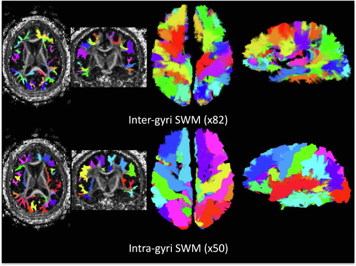 Short superficial white matter and aging: A longitudinal multi-site study of 1293 subjects and 2711 sessions