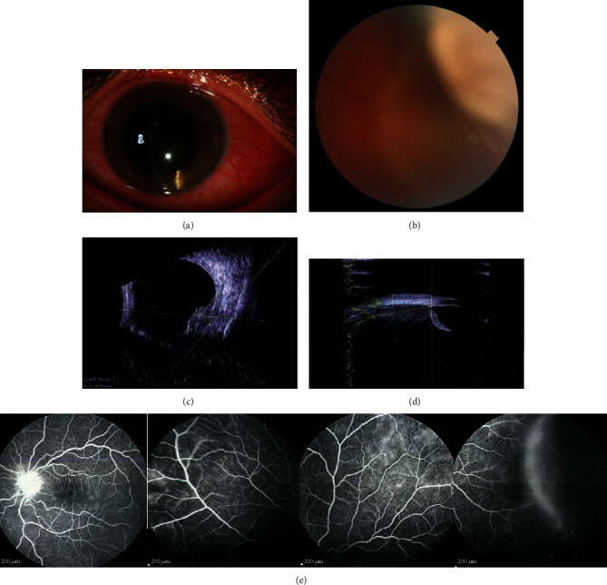 Langerhans Cell Histiocytosis of the Uvea with a Ciliochoroidal Mass: A Case Report of Management with Systemic Therapy.