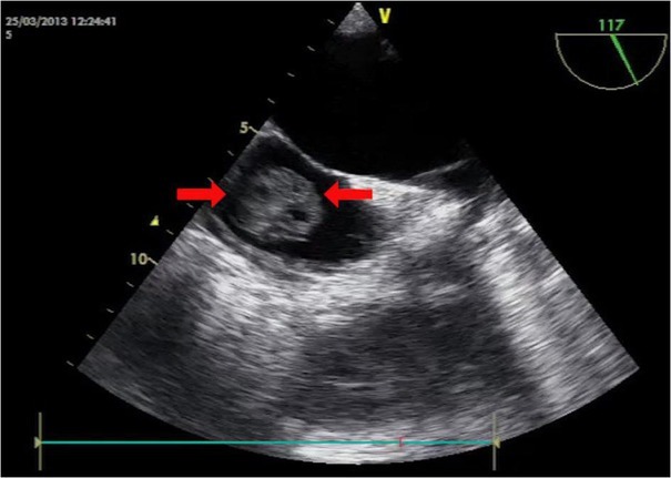 The Role of Intraoperative Transesophageal Echocardiography in the Management of Renal Cell Carcinoma with Atrial Thrombus - Case Report.