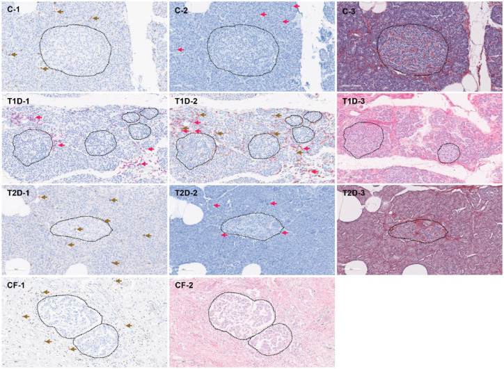 Immune cell infiltration in the pancreas of type 1, type 2 and type 3c diabetes.