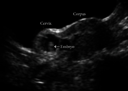 Cesarean Scar Pregnancy and Successful Ultrasound-Guided Removal after Uterine Artery Ligation.