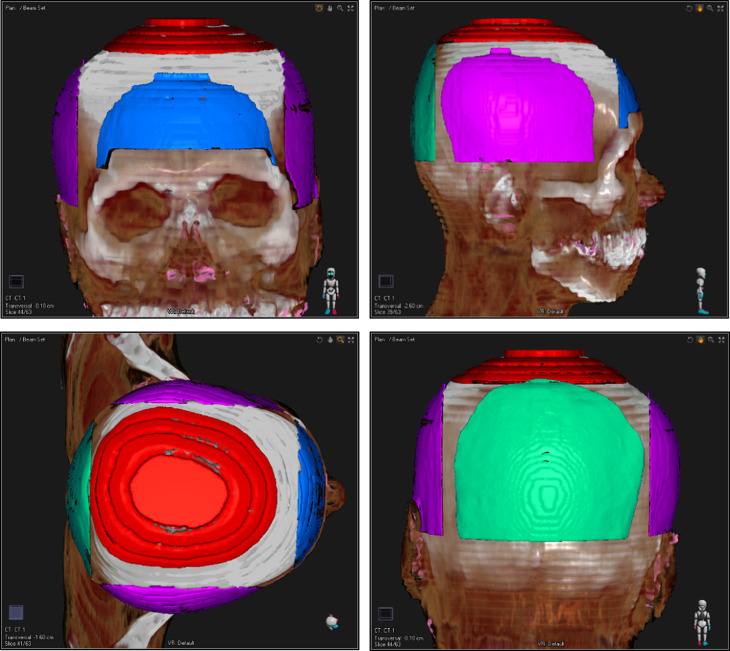 Dosimetric investigation of whole-brain radiotherapy with helical intensity modulated radiation therapy and volumetric modulated arc therapy for scalp sparing.