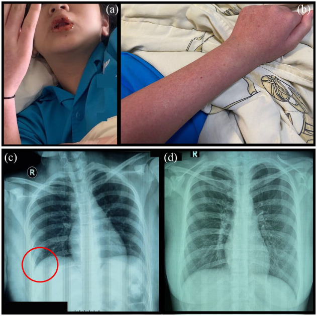 Significant improvement of systemic lupus erythematosus manifestation in children after autologous dendritic cell transfer: a case report and review of literature.