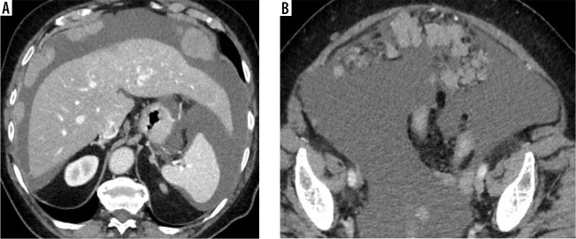 Diagnosis and treatment of peritoneal carcinomatosis - a comprehensive overview.