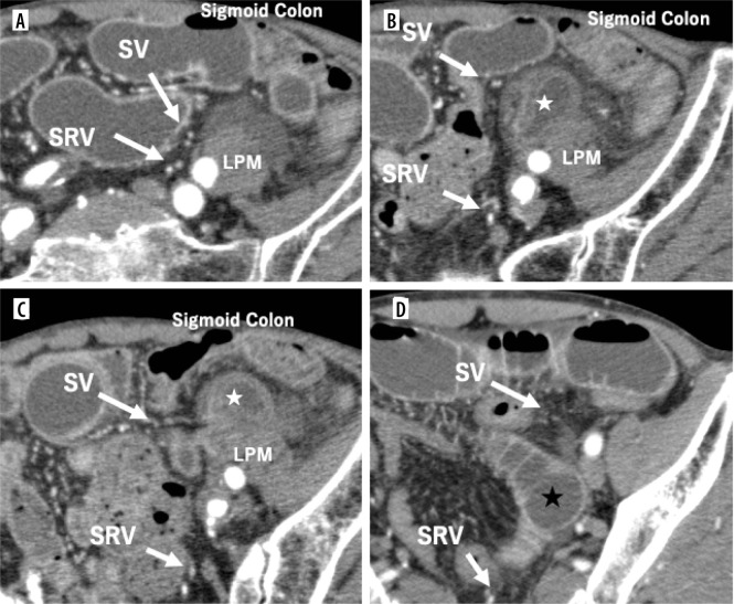 Computed tomography findings of intersigmoid hernia.