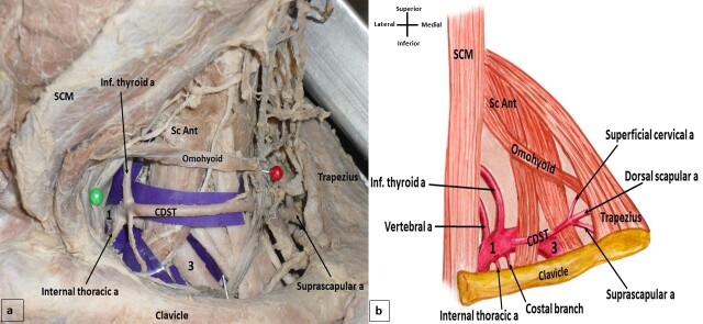 Bilateral variation in the branching pattern of the subclavian artery: an unusual finding with clinical implications.