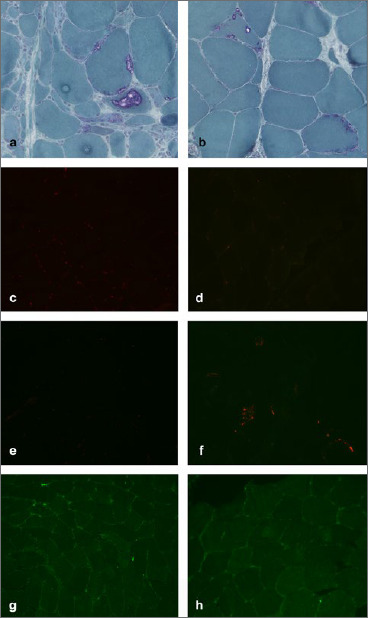 VCP-related myopathy: a case series and a review of literature.