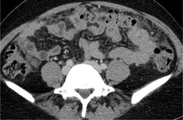 Diagnosis and treatment of peritoneal carcinomatosis - a comprehensive overview.