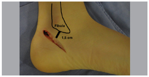 MODIFIED MUBARAK TECHNIQUE FOR FLEXIBLE FLATFOOT CORRECTION IN CHILDREN AND ADOLESCENTS.