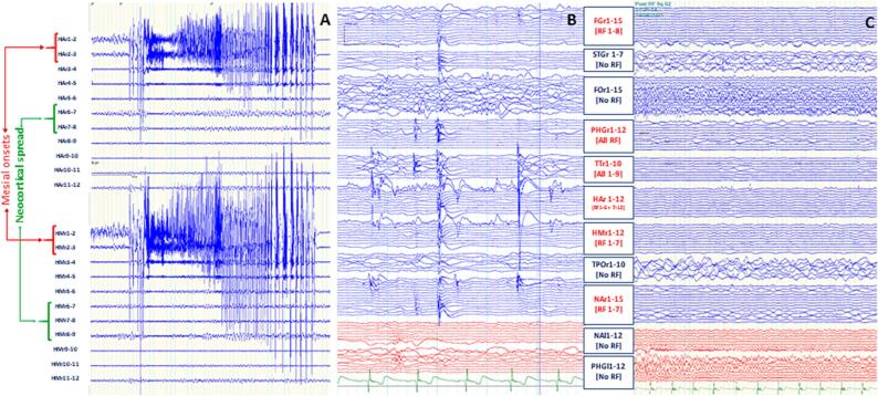 SEEG-RF for revealing and treating Geschwind syndrome's epileptic network: A case study