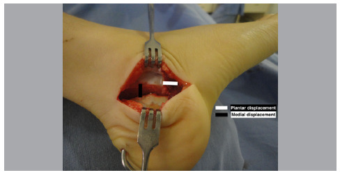 MODIFIED MUBARAK TECHNIQUE FOR FLEXIBLE FLATFOOT CORRECTION IN CHILDREN AND ADOLESCENTS.