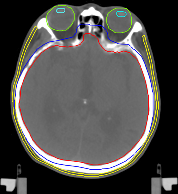 Dosimetric investigation of whole-brain radiotherapy with helical intensity modulated radiation therapy and volumetric modulated arc therapy for scalp sparing.