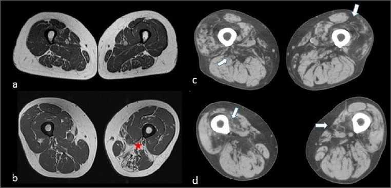 VCP-related myopathy: a case series and a review of literature.