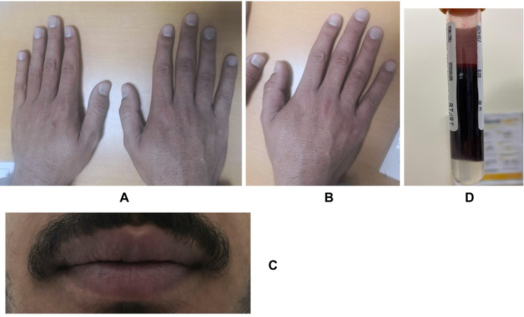 Congenital Methemoglobinemia: First Confirmed Case in the Arab Population with a Novel Variant in the <i>CYB5R</i> Gene in the State of Qatar: A Case Report.