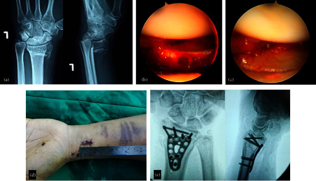 Minimally Invasive Plating of Distal Radius Fracture: A Series of 42 Cases and Review of Current Literature.