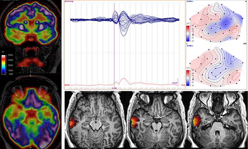 SEEG-RF for revealing and treating Geschwind syndrome's epileptic network: A case study