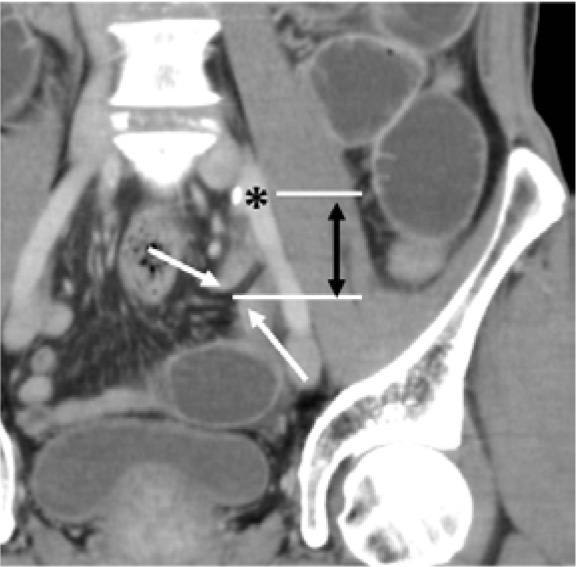 Computed tomography findings of intersigmoid hernia.