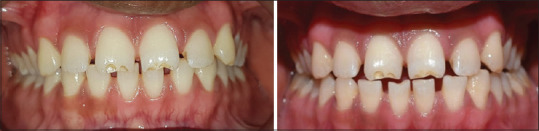 Integration of Digital and Analog Workflow to Achieve Predictable Esthetics: A Novel Approach.