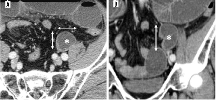 Computed tomography findings of intersigmoid hernia.