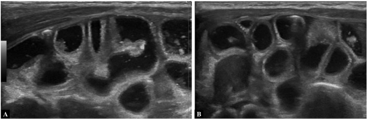 Sonographic Rectal Enema ("hydrocolon") for Diagnosing Large Bowel Pathologies in Infancy - Pictorial Review to Demonstrate Feasibility and Value.