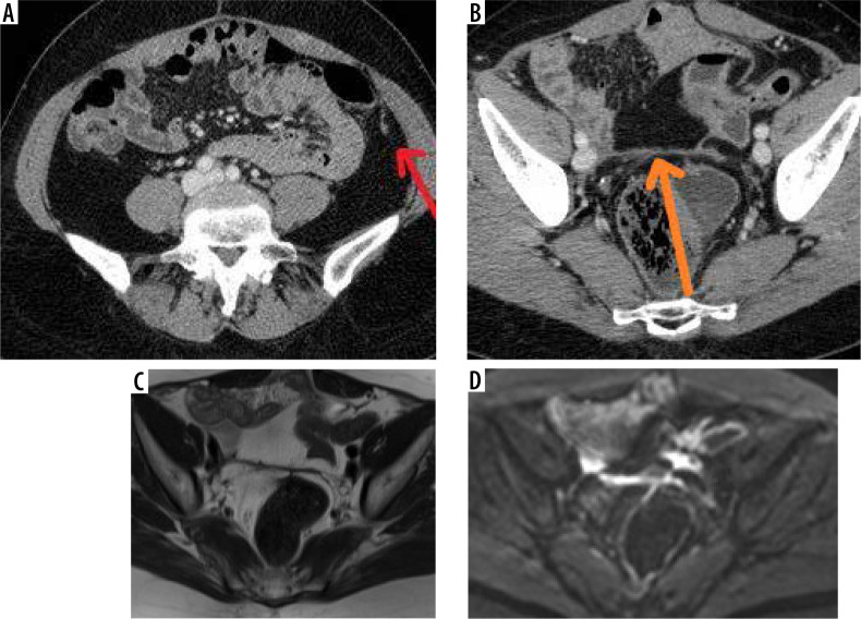 Diagnosis and treatment of peritoneal carcinomatosis - a comprehensive overview.