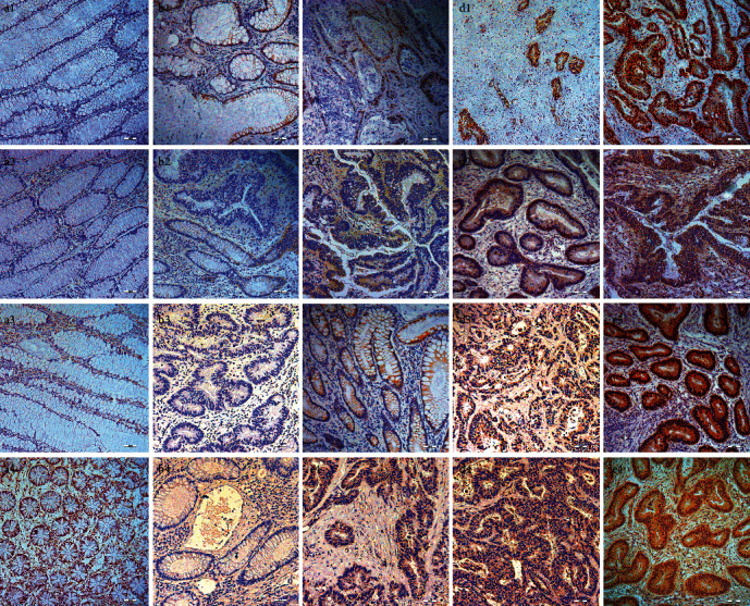 A-Kinase Anchor Protein 95 Is Involved in ERK1/2-Elk-1 Signal Transduction in Colon Cancer.