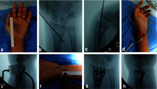 Minimally Invasive Plating of Distal Radius Fracture: A Series of 42 Cases and Review of Current Literature.