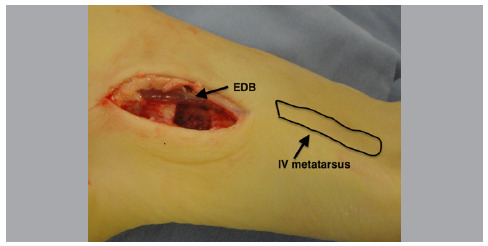 MODIFIED MUBARAK TECHNIQUE FOR FLEXIBLE FLATFOOT CORRECTION IN CHILDREN AND ADOLESCENTS.