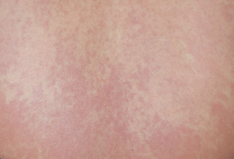 Lithium-Induced Cutaneous Pseudolymphoma.