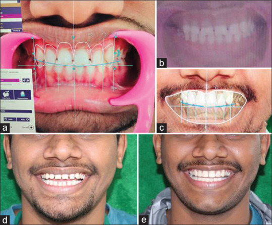 Integration of Digital and Analog Workflow to Achieve Predictable Esthetics: A Novel Approach.